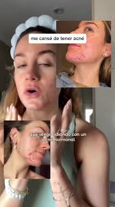 Después de más de 2 años probando de toooooodo para dejar de brotarme, no  me quedó otra más que empezar con la medicación porque realmente me  generaba mucha inseguridad y quería que me deje de pasar. ...