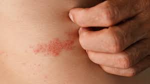 Image result for shingles in children