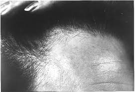 The possible hair thinning is related to loss of estrogen and is nothing like hair loss from chemo. Alopecia And Breast Disease The Bmj