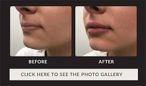 Liposuction is performed with a very small incision that hides very well and is nearly imperceptible, creating a very natural result. Fillers In Houston Juvederm Restylane Sculptra More