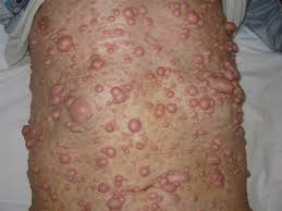 Also known as von recklinghausen disease, nf1 mostly affects nerves of the outer parts of the body (peripheral nervous system). A Patient With Loss Of Vision In The Right Eye And Neurofibromatosis Type 1 Cmaj