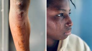 SFX3Prothèses Transferts