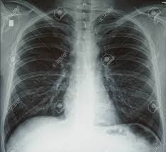Check spelling or type a new query. Plain Chest X Ray Normal Healthy Lungs Black And White Lizenzfreie Fotos Bilder Und Stock Fotografie Image 149390638