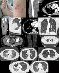 Maybe you would like to learn more about one of these? Clinical Assessment Of A Nocardia Pcr Based Assay For Diagnosis Of Nocardiosis Journal Of Clinical Microbiology