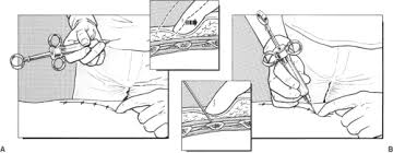 Image result for Intrapleural Anesthesia