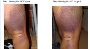 Pin On Total Knee Arthroplasty