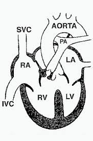 Pathophysiology, clinical features, and diagnosis of tetralogy of fallot uptodate.com. Cardiovascular Pathology