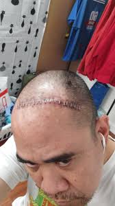 I just won two battles of my life.” The year 2020 was a memorable one for  this 35-year-old man from Manila, who found out he has brain tumor days  after testing positive