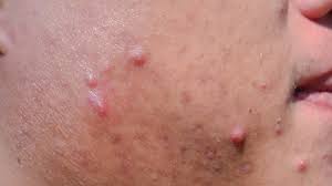 Heal mouth sores & stop future outbreaks. Cyst Pictures Causes Types Treatments And Prevention