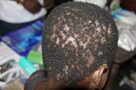 Damage and necrosis of hair follicles after scalp trauma are actually the result of the body's own natural defense mechanisms: 5 Year Old Male With Patches Of Hair Loss The Doctor S Channel