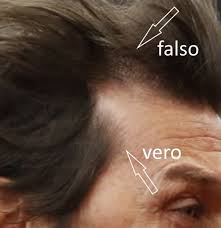 Sono tanti gli sportivi che negli ultimi anni hanno fatto ricorso al trapianto di capelli, come ad esempio antonio conte, wayne rooney ed altri. Conte Protesi O Trapianto Protesi Reinfoltimenti Non Chirurgici Salusmaster