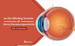 Image result for Vernal Conjunctivitis