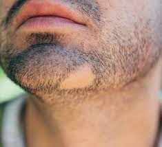 To grow facial hair, there a couple things you can do. Bald Patch In Beard Causes And Treatments