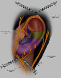 Image result for Forehead Regional Block