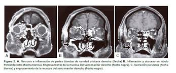 Pía spalloni m, patricia glaser k, patricia verdugo l. Coinfeccion De Mucormicosis Rinocerebral Y Aspergilosis Sinusal Torres Damas Revista Peruana De Medicina Experimental Y Salud Publica