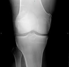 Palpable as a hard, rounded bump to the inside of either knee joint, they are one of two condyles at the bottom of each leg bone, the other being the lateral femoral condyle. Epos Trade