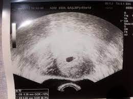 Hat Jemand Von Euch Bei 5 1 Auch Noch Nix Auf Dem Ultraschall Gesehen Forum Fur Januar 2013 Mamis