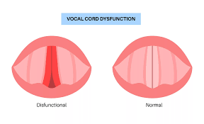 Image result for Vocal Cord Dysfunction