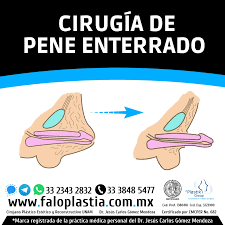 Trans lograron que obras sociales cubran cirugías para adecuarse a su nueva identidad. Faloplastia Photos Facebook
