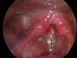 Image result for Reflux Laryngitis