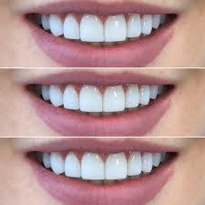 Diseño de Sonrisa