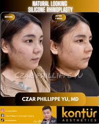 PAHELP PLS ANO PO MAS BETTER SILICON,GOROTEX OR CARTILAGE GOROTEX??