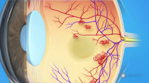 Maybe you would like to learn more about one of these? Diabetic Eye Disease American Academy Of Ophthalmology