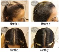 Hair loss affects millions of women all over the world and there is always a solution, unique to each individual. Women S Hair Loss Treatment Success Stories