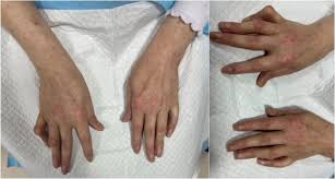 Image result for Connective Tissue Disorder