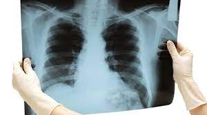 Die abkürzung copd steht für chronisch obstruktive lungenerkrankung (chronic obstructive pulmonary außerdem führt eine copd zu bluthochdruck in der lunge und zu einer herzschwäche. Copd Schleichend Geht Die Lunge Kaputt