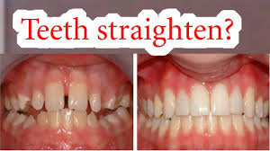 For the majority of patients, teeth straightening with dental braces may take anywhere between just 6 months and 2 years. How Do Braces Straighten Your Teeth Youtube