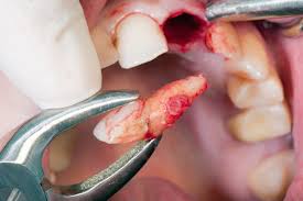 Image result for Tooth Extraction