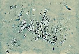 脳がカビに支配される 治らない湿疹 過敏性腸症候群 歯周病 膣カンジタは内臓にはびこるカンジタ菌の仕業だとしたら カンジタ菌 過敏性腸症候群 不妊治療