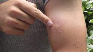 Stellen sie auch nach diesem zeitraum noch. Allergische Reaktion Auf Wespenstich Was Tun