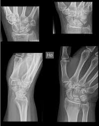 Image result for Wrist XRay