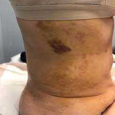 Sergio alvarez, md is a cosmetic, plastic & reconstructive surgery specialist in miami, fl and has over 14 years of experience in the medical field. Mia Aesthetics Miami 44 Photos 112 Reviews Plastic Surgeons 9300 Sw 72nd St Miami Fl United States Phone Number Yelp