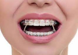 Elastics are used in both braces and invisalign treatment to align your bite and. Elastics Rubber Bands In Orthodontic Treatment Jeff Thompson Orthodontics Leawood Kansas