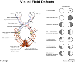 Visual Field Defects Ophthalmology Medbullets Step 2 3