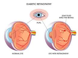 Annual Dilated Eye Exams Key In Preventing Diabetic Eye Disease Cbs Baltimore