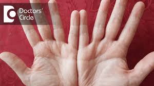 Some people experience peeling skin more than others. Causes Of Peeling Palms And Its Natural Home Treatments Dr Amee Daxini Youtube