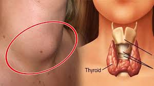 If it's healthy, each lobe is about the size of a quarter and you won't see or feel it under your skin. 10 Signs You May Have A Thyroid Problems Symptoms Of Thyroid Problem Be Wise Live Wis Symptoms Of Thyroid Problems Hypothyroidism Symptoms Thyroid Symptoms
