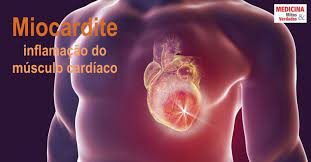 O tratamento depende da fonte e da gravidade da inflamação miocárdica. Inflamacao Do Musculo Cardiaco Miocardite Medicina Mitos E Verdades