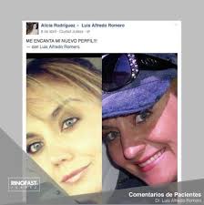 Rinoplastia en Ciudad Juárez y EL Paso, TX