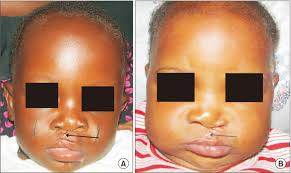 A. Postoperative clinical picture of a 6-month-old male following...