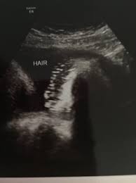 It looks beautiful as nursery art and makes a special baby shower gift. Hair On Ultrasound Page 2 Babycenter