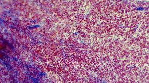 Limfomul non hodgkin (lnh) este un tip de cancer care afecteaza sistemul limfatic si in care mult mai frecvent decat boala hodgkin, alaturi de care formeaza afectiunile maligne ale sistemului un medic va pune diagnosticul de limfom non hodgkin in urma anamnezei si examenului fizic, cu. Lymphdrusentumoren Non Hodgkin Lymphome Gesundheitsgesprach Bayern 2 Radio Br De