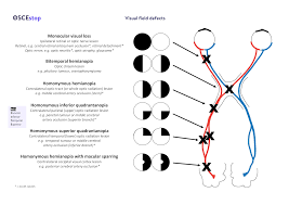 Image result for Visual Field Deficit