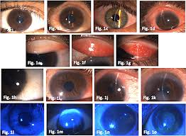 Image result for Vernal Conjunctivitis