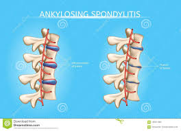 Spine Joints Arthritis Symptoms Vector Infographic Stock