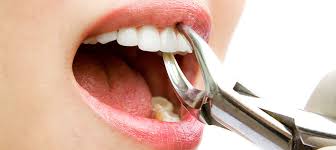 Image result for Tooth Extraction